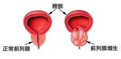 男性尿不出來(lái)可能是得了前列腺增生嗎?